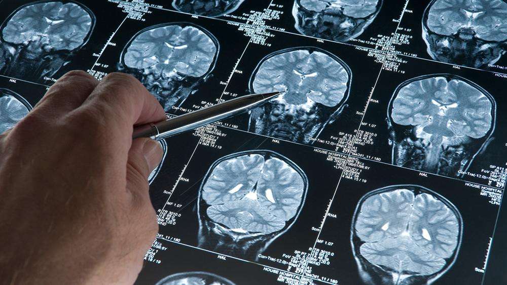 What Triggers Alzheimer's Disease?