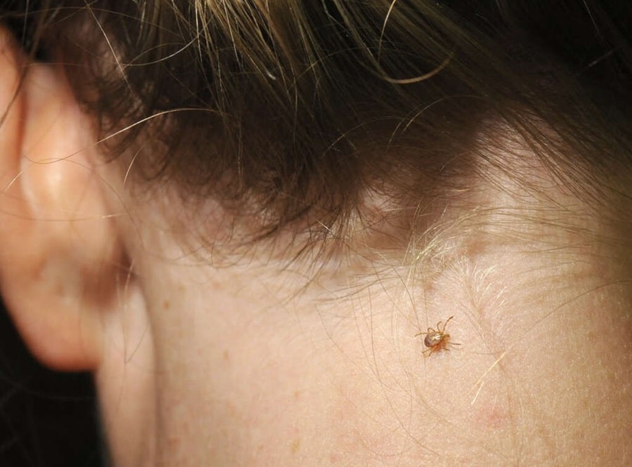 The Alarming Rise of Lyme Disease: How to Protect Yourself
